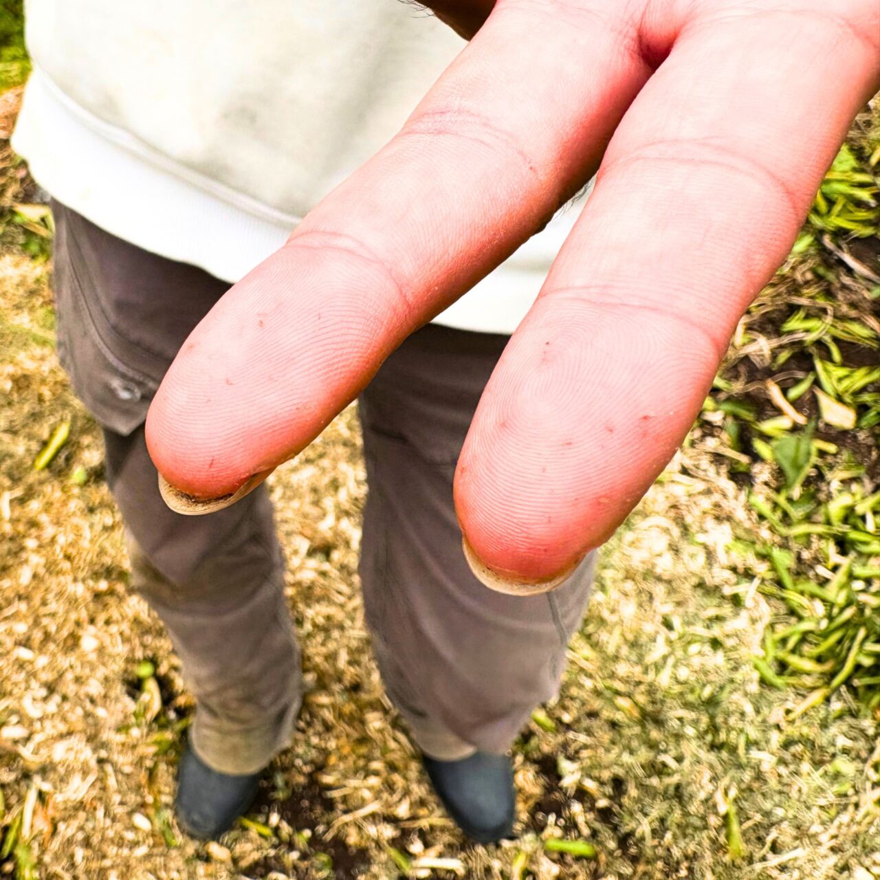 福本さんの手に刺さったままになっているせとかの棘
